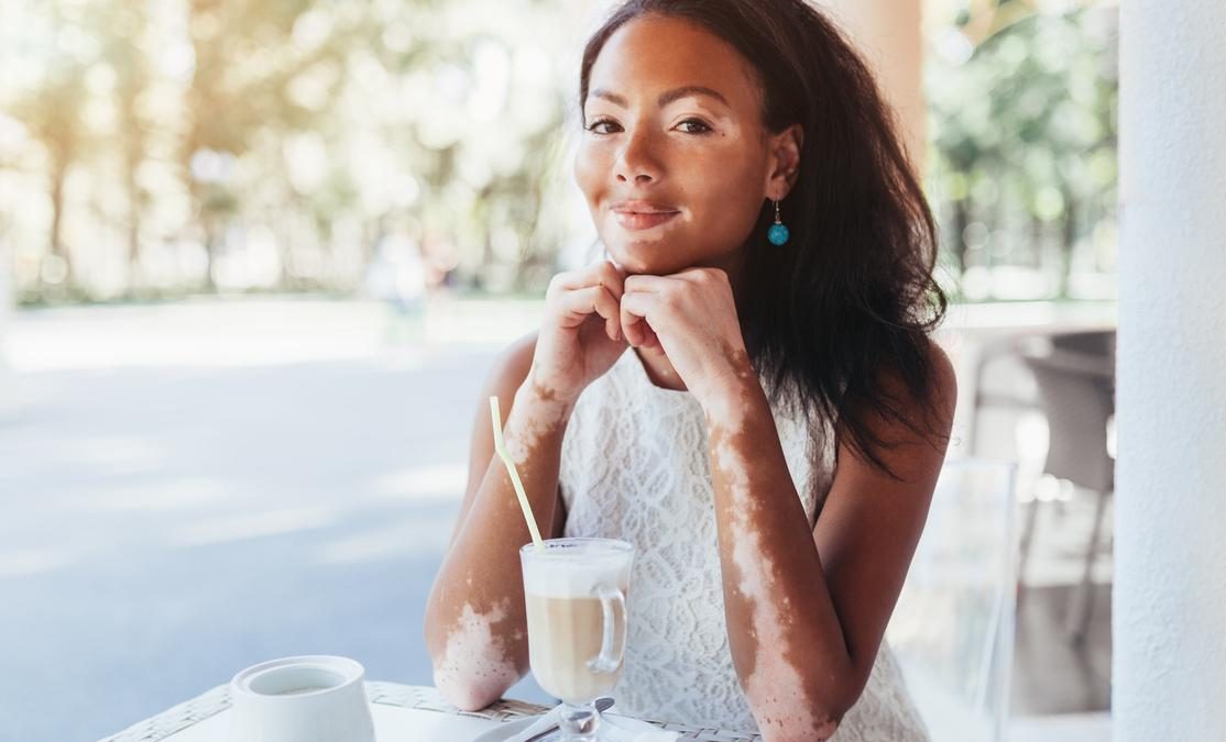  Vitiligo : causes, symptômes et traitement 