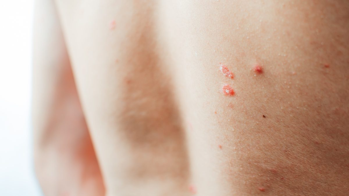  Psoriasis en gouttes : des symptômes au traitement 
