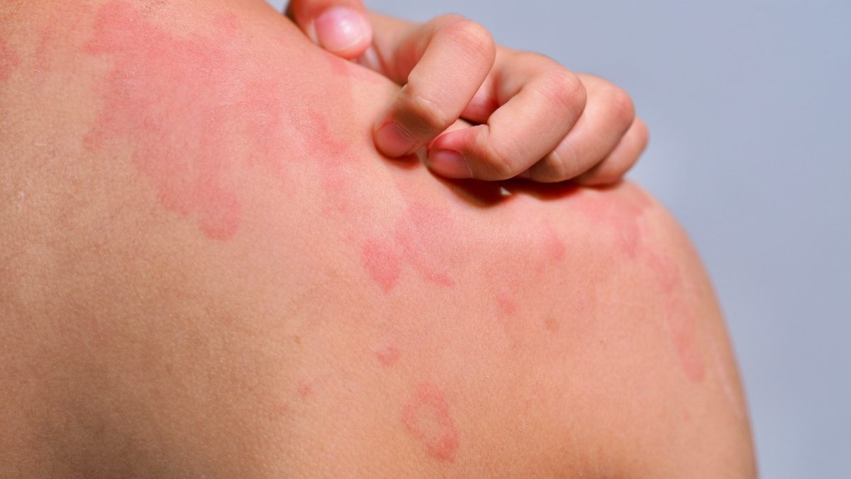  Urticaire cholinergique : définition, causes, symptômes, traitements 