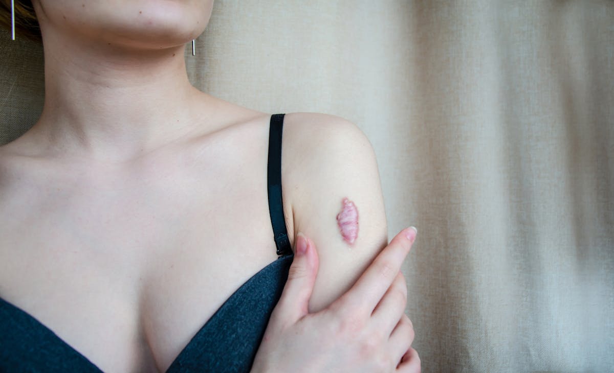 
                Chéloïde : comment traiter cette cicatrice ? 
                            