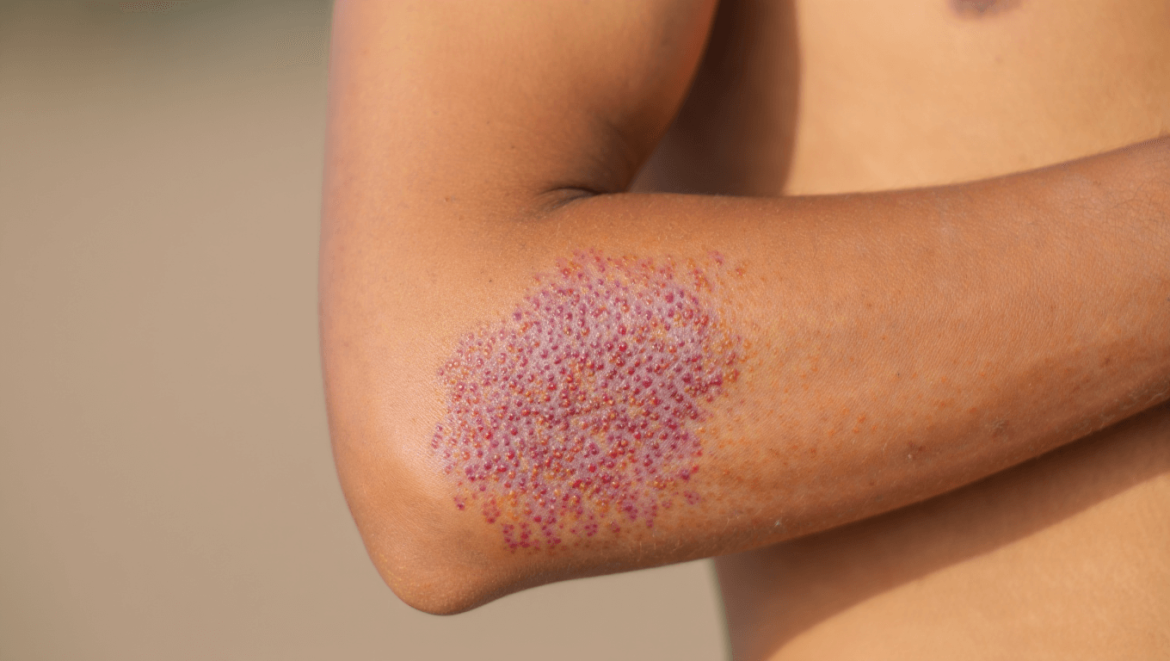 Lichen plan : définition,
symptômes, causes et traitements