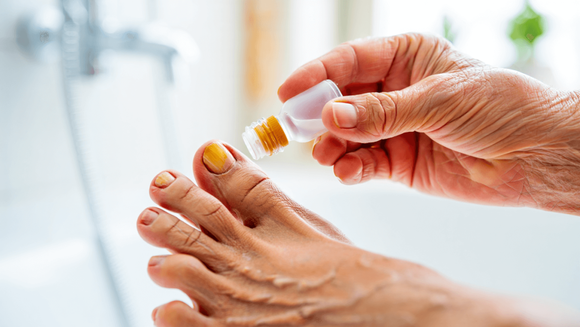 Comment soigner naturellement
une mycose de l’ongle ?