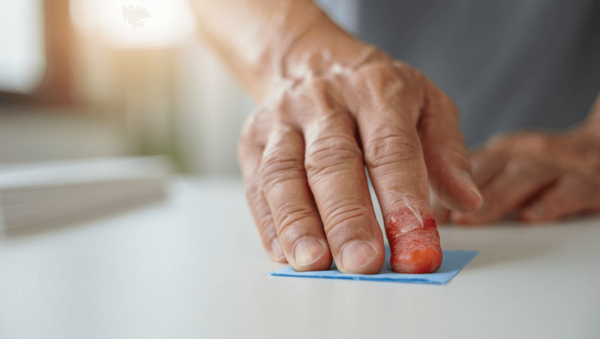 Arthrite du doigt : causes , symptômes, traitements