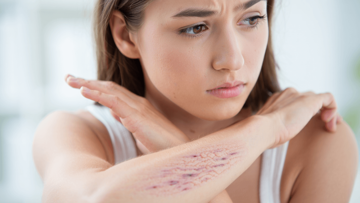 Tatouer ses vergetures pour les masquer : bonne ou mauvaise idée ?