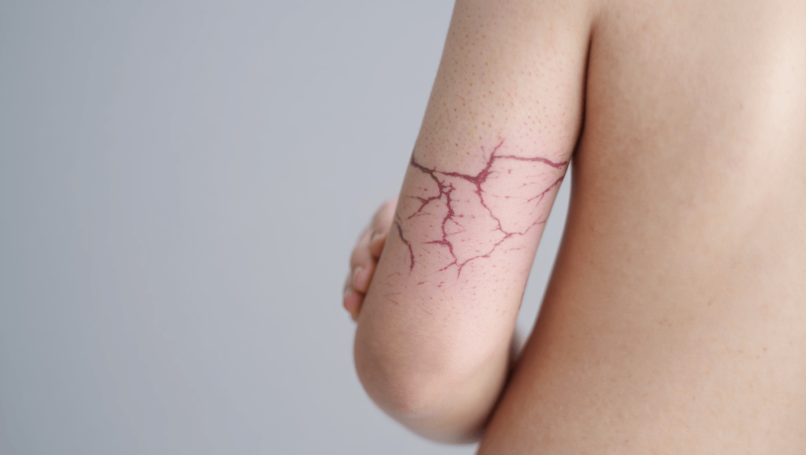 Peau marbrée : faut-il s'inquiéter ?