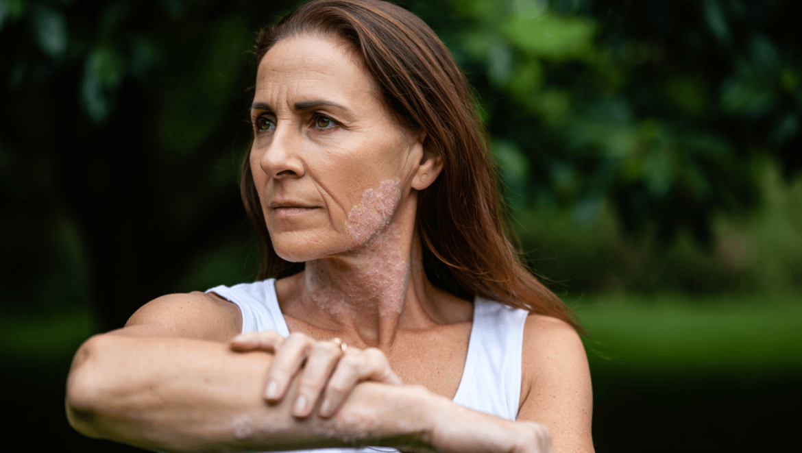 Soulager le psoriasis avec du
bicarbonate de soude ?