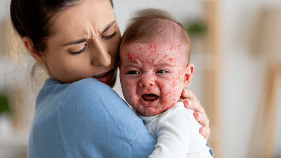 Eczéma atopique nourrisson